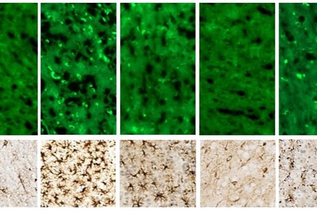 Aggregazione della proteina amiloide e neuroinfiammazione in una sezione di cervello di topo (fonte:  Fraldi/CEINGE)