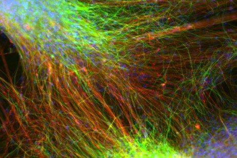 Neuroni differenziati a partire da cellule staminali embrionali impiantati in malati di Parkinson nella sperimentazione condotta in Europa (fonte: Malin Parmar Lab)