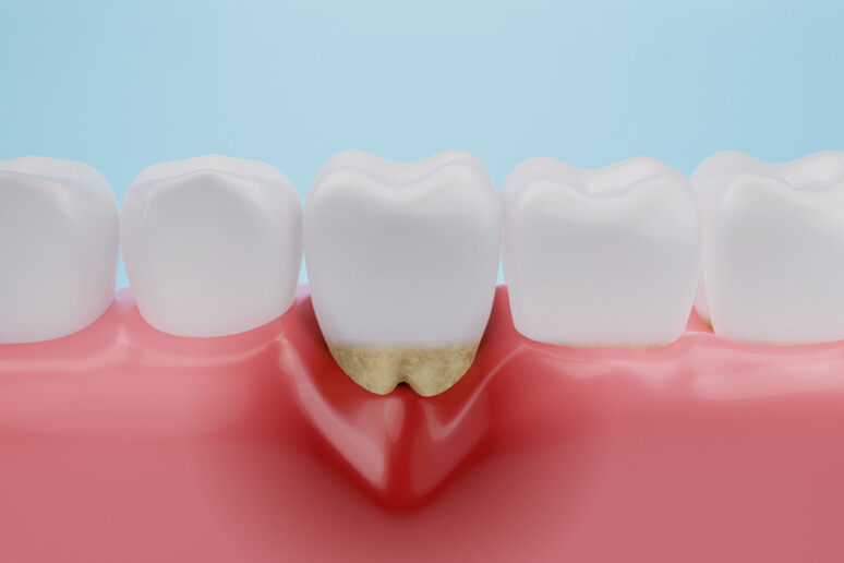 La cura delle gengive può ridurre rischio morte per demenza - RIPRODUZIONE RISERVATA